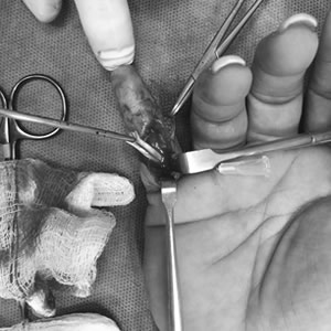 Tratamiento y Cirugía para Lesiones de Tendones y Ligamentos